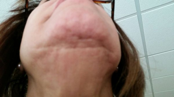 Here is what happens when you get liposuction to tighten your jawline....