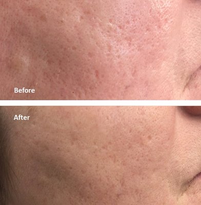 Laser Acne Scar Removal- 1 Treatment Session