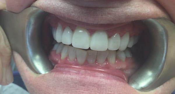 After veneers