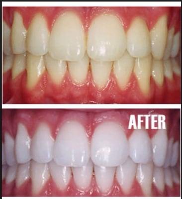 Teeth Whitening