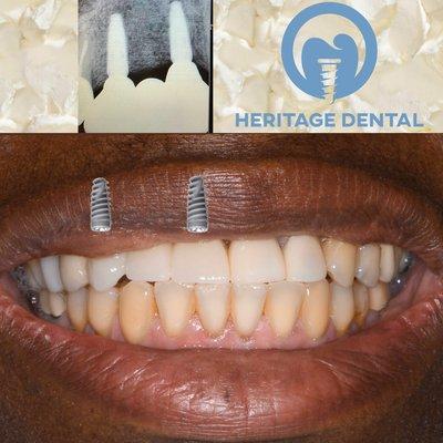 Implant bridge that blends in with your other teeth