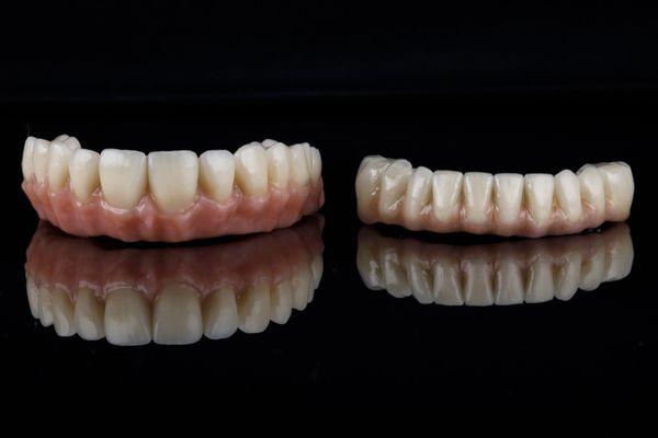 Hybrid Implant Dentures