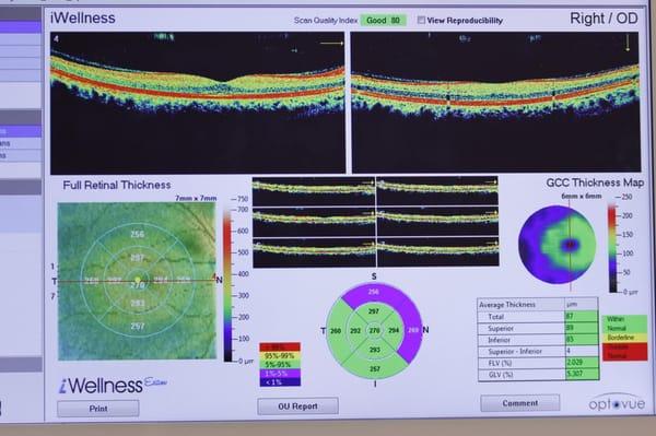 The iWellness exam images the individual layers of the retina for early disease detection.