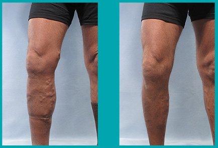 Before and After varicose vein treatment. We care about your health. Make an appt. at 773-227-3132