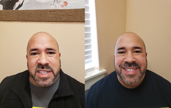 Before & after results of acupuncture treatment on a patient with Bell's Palsy.