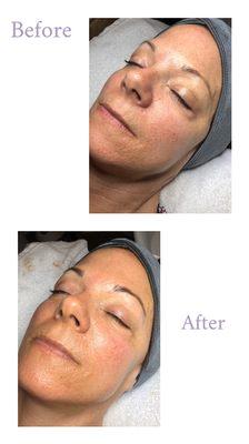 Osmosis facial infusion treatment before & after one treatment