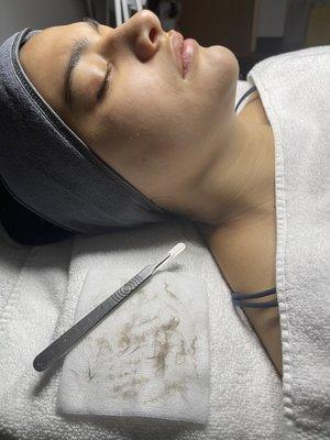 Dermaplaning Procedure