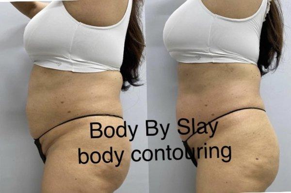 Body contouring