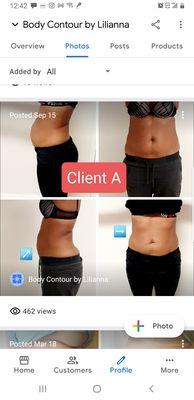 This is the clients results that left a negative review. Claims no results but photos show a different story.