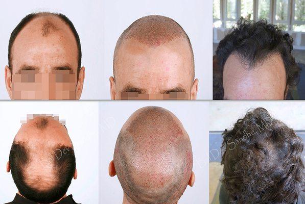 Hair Transplant New Jersey