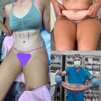 Tummy Tuck