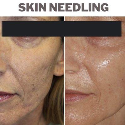 Skin Needling for Brighter Complexion