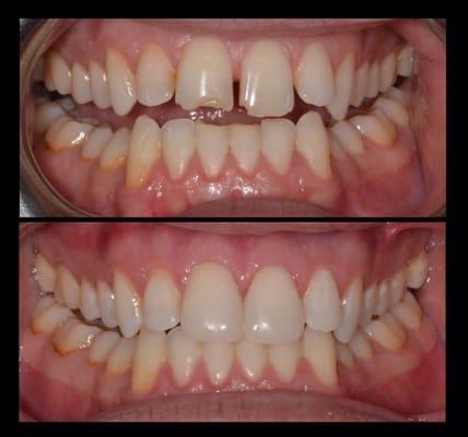 Composite bonding to repair broken teeth and close spaces. This is a conservative, affordable alternative to porcelain veneers.