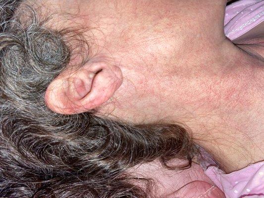 Cutaneous/ear cannal