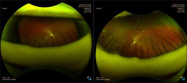 Optos retinal camera lets you see images of the backs of your eyes. Awesome.