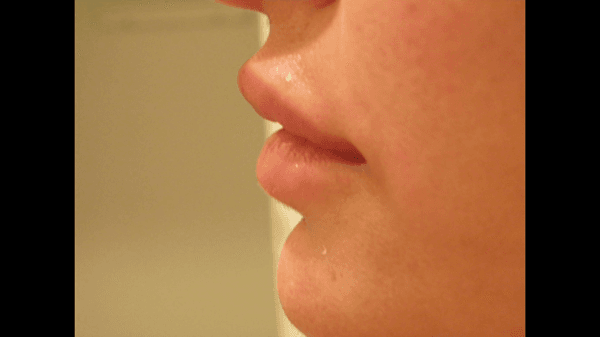 Lip augmentation after