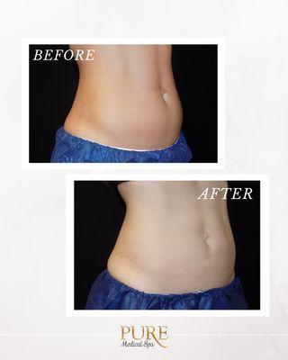 CoolSculpting - Abdomen