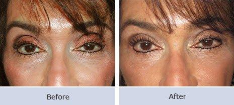 Eyelid Surgery Before & After