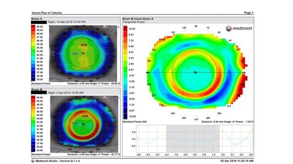 Customized Orthokeratology Lens for Myopia