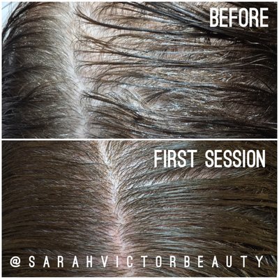 Scalp microblading