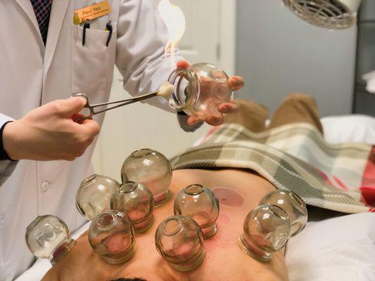 Fire Cupping Treatment