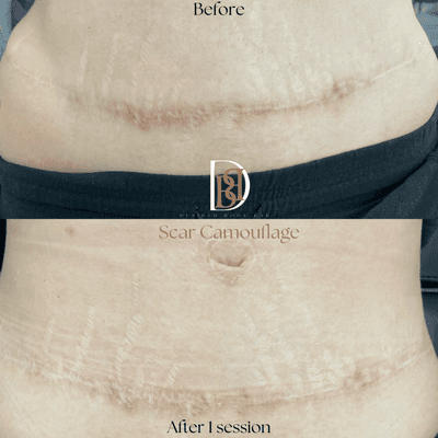 Client progress from 1 session of scar lighting