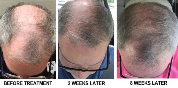 Hair Restoration after one treatment!