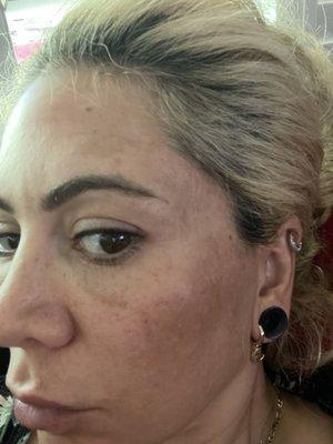 Side face cheek melasma . Third day of the chemical peel . No peeling or red .