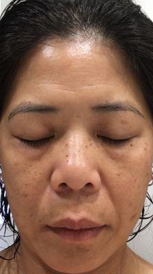 Client with hyperpigmentation before treatment.