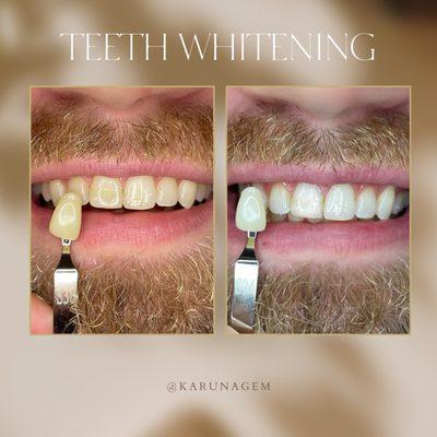 15 Minute Whitening Session.