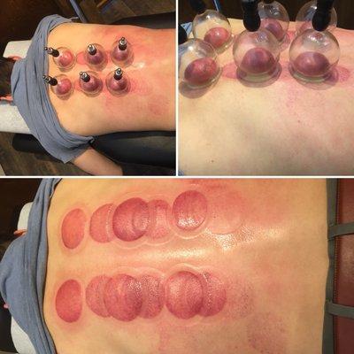 Cupping therapy. It looks worse then if feels ; )