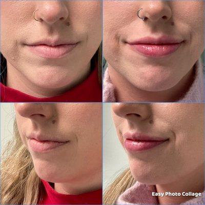 Lip filler: before and after