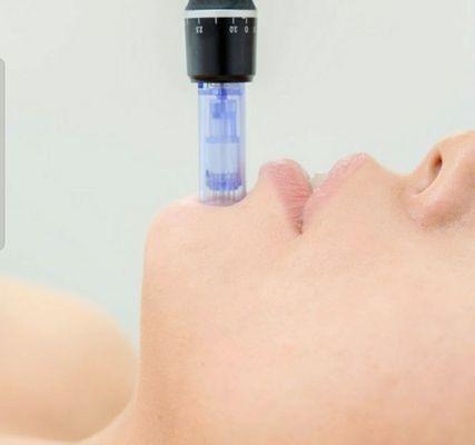 Microneedling treatments, $999 for course of 6