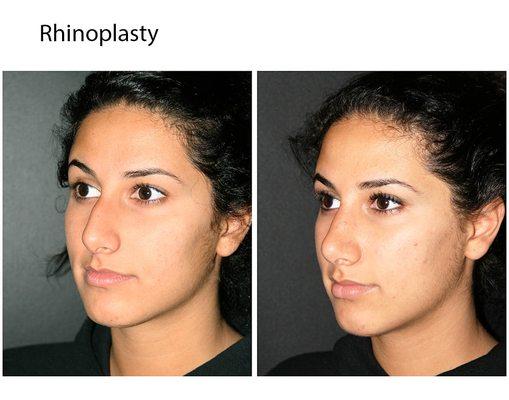 Rhinoplasty