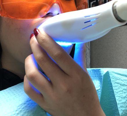 Teeth whitening. Glasses so your eyes are safe.