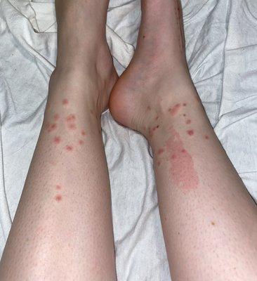 Bed bug bites from the bed I slept in