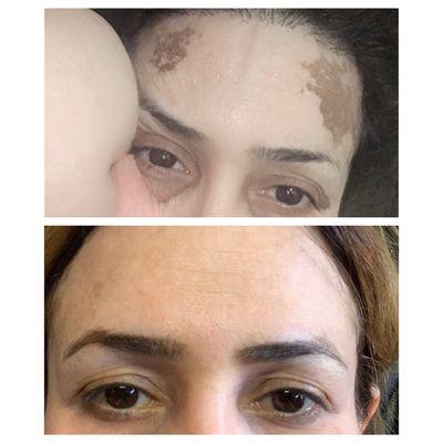 Before & after using our Q-Switch laser to remove hyperpigmentation!