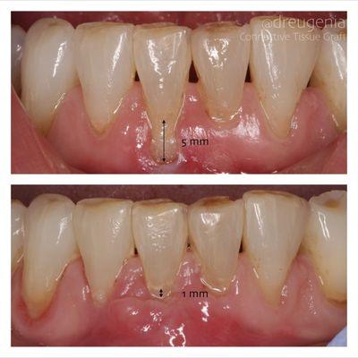 Connective Tissue Graft to treat root exposure