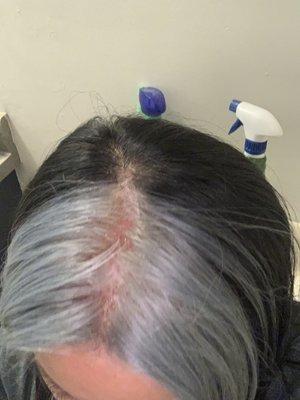 Scalp burning aftermath