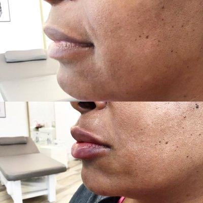 Juvederm Ultra