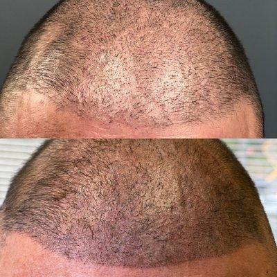 Scalp Micropigmentation to create density to thinning hair lines