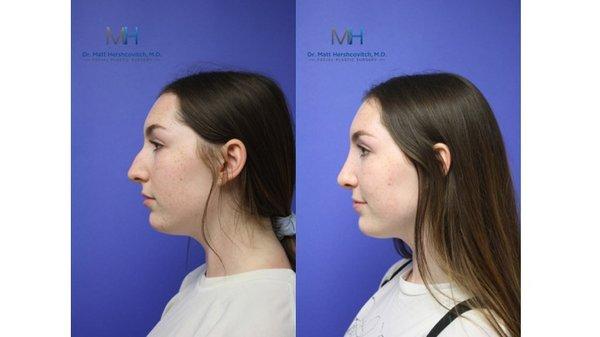 Rhinoplasty Before and After