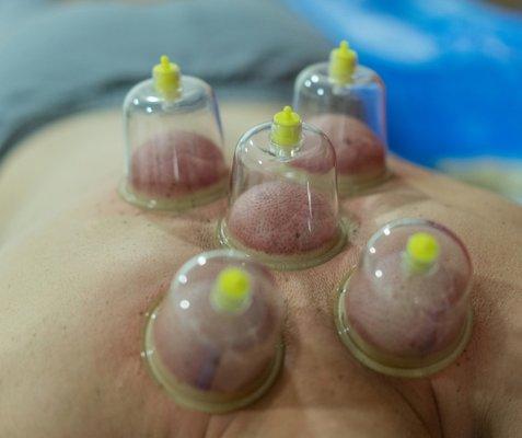 Cupping to bring bloody flow and decrease tension in the upper back before proceeding with deep tissue techniques