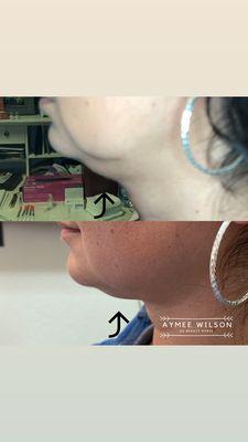 1 session of Kybella