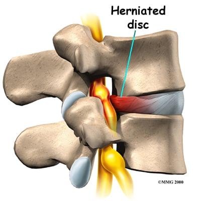 Herniated disc close up