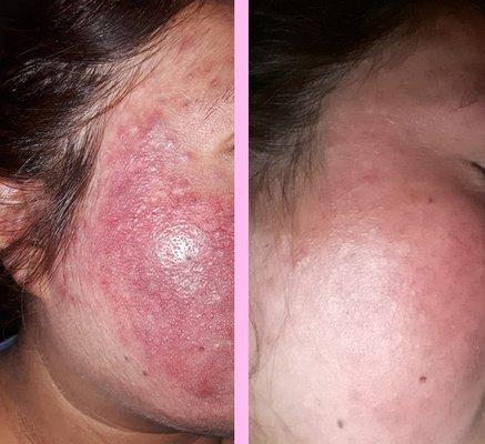 Dramatic reduction of inflammation and breakouts in just a few weeks. Work in progress.