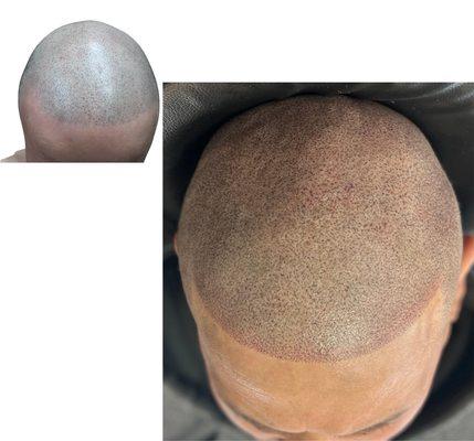 Scalp Micropigmentation (SMP) NJ Hair Loss Solution