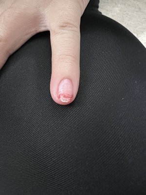 Nail bled because of the glue stuck on the skin.