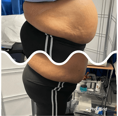 Before and after fat cavitation and lipo