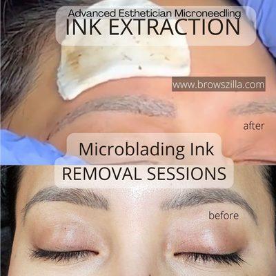 Microblading removal with medical microneedling tattoo ink extraction procedure